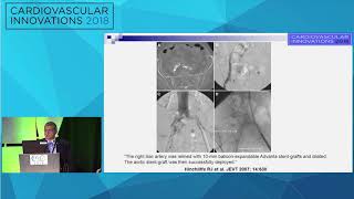 CVI2018 Session How to manage nondilatable heavily calcified iliacs  Nicolas Shammas MD [upl. by Arratal263]