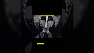 Dextrocardia with situs Inversus pixelart newjeans animefnf anatomyctangiography comedyvideos [upl. by Candie]