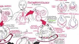 Emphysema  Pathophysiology COPD [upl. by Donica112]