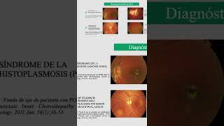 Síndrome de la Histoplasmosis Ocular [upl. by Enoob]