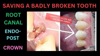 SAY NO TO TOOTH EXTRACTION  SAVE TOOTH BY ROOT CANAL  ENDOPOST  ZIRCONIUM CROWN [upl. by Kirch]