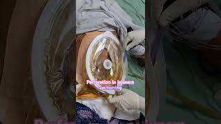 Jejunal perforation suction A life saving procedure Full video comming soon icucare [upl. by Irish]