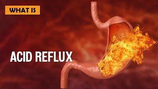 What is Acid Reflux [upl. by Carrnan933]