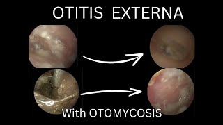 Otitis Externa with OTOMYCOSIS  2CASES  Cleaning Tips for Ear [upl. by Ethan]