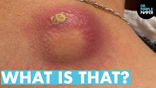 WHAT IS THAT Dr Lee Pops Satisfying Back Cyst  Dr Pimple Popper Reacts [upl. by Eocsor]