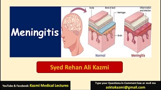 Meningitis  Neurology  Pediatric Review  KML [upl. by Eirhtug]