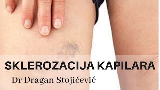 Uklanjanje proširenih kapilara skleroterapija sklerozacija vena cene cena cenovnik [upl. by Jeramie]