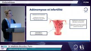 Adénomyose et infertilité — Dr M Bourdon [upl. by Marquez]