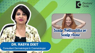 ACNE OR PIMPLES ON SCALP  Scalp Folliculitis  Causes amp Treatment DrRasya Dixit  Doctors Circle [upl. by Paehpos683]