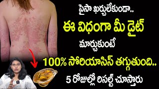 100 సోరియాసిస్ తగ్గుతుంది  Psoriasis Treatment  Psoriasis Diet play a vital role in curing [upl. by Afra]