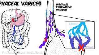 Portal Hypertension Animated Review [upl. by Margette]