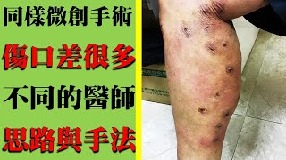 同樣都是微創手術，為什麼傷口差很大？｜許原彰醫師：台北，台中，高雄，台南，新竹，桃園，靜脈曲張專家 [upl. by Kamal196]