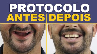 8 Casos de Implantes Protocolo  Antes e Depois [upl. by Arihsak754]