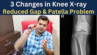 Knee x ray Knee Osteoarthritis Gap Reduced Chondromalacia patella Knee Joint Degeneration [upl. by Aynas]