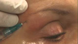 Brow Lift Using Dermal Filler Instructions by Skinspirations [upl. by Brunelle]