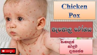 Chickenpox diseaseපැපොල රෝග තත්ත්වයcauseshow it happenstreatmentssinhalahow to prevent [upl. by Mapel]