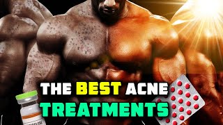 The MOST Effective Acne Treatments for guys on gear AND nattys [upl. by Assir137]