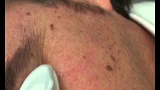 Doctor Beauty  Laser Erbium YAG skin resurfacing with Pluser Fraxtion [upl. by Friedrich]