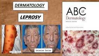 DERMATOLOGY  LEPROSY tuberculoid amp lepromatous derma lesion leprosy [upl. by Anirbed648]