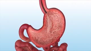 How is the Gastric Balloon Inserted and Removed [upl. by Alul]