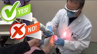 Toenail Fungus Laser Treatment Success Rate Is it Really Worth or Not [upl. by Eninej804]