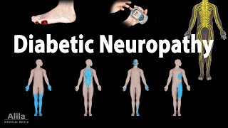 Diabetic Neuropathy Animation [upl. by Flyn]