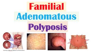 “Colon Cancer That Runs in Families” Familial Adenomatous Polyposis APC Gene Symptoms Treatment [upl. by Nuyh]