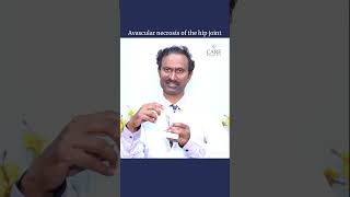 Avascular Necrosis of the Hip Joint  Dr Anand Babu Mavoori  CARE Hospitals Musheerabad [upl. by Dauf377]