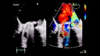 ROCKING MOTION  Major dehiscence of infected mitral valve prosthesis [upl. by Nue451]