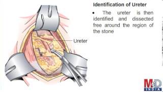 open ureterolithotomy [upl. by Essiralc]