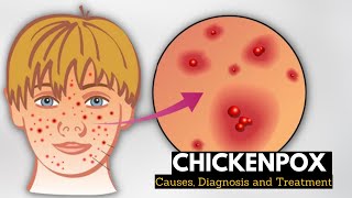 Chickenpox Causes Signs and Symptoms Diagnosis and Treatment [upl. by Madeline]