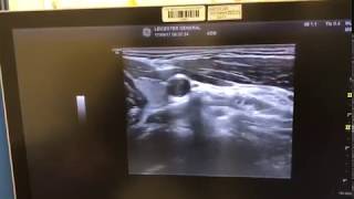 Cervical Sympathetic Chain Stellate Ganglion Block using Ultrasound [upl. by Juliane637]