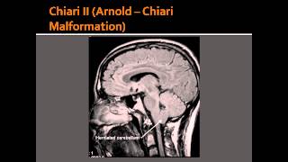 Chiari II  ArnoldChiari Malformation  amp DandyWalker Syndrome [upl. by Ragucci]