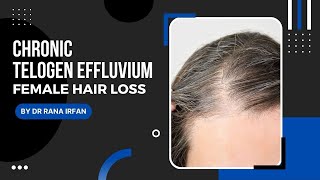 Chronic Telogen Effluvium  Female Hair Loss Treatment  By Dr Rana Irfan [upl. by Eylatan]