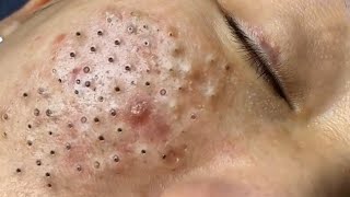 Big Cystic Acne Blackheads Extraction Blackheads amp Milia Whiteheads Removal Pimple Popping  3630 [upl. by Nilyad398]