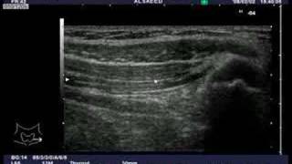 Ultrasound guided IlioinguinalIliohypogastric nerve block [upl. by Saisoj]