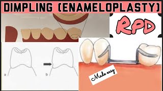 DIMPLING ENAMELOPLASTY II PROSTHETIC MOUTH PREPARATION II REMOVABLE PARTIAL DENTURE I PROSTHODONTICS [upl. by Jews]