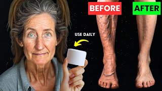 Barbara ONeills Reveals Varicose Vein Treatment ENDS 20 Years of Leg Pain [upl. by Godric]