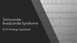 TachycardiaBradycardia Syndrome ECG Findings Explained [upl. by Notsrik77]