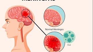 Meningitis what you need to know short fyp howto [upl. by Wrench]