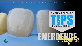 diastema closure technique tips [upl. by Aggy]