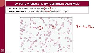 Hematology  1  U7L1  Introduction to microcytic hypochromic anaemias [upl. by Moriyama]