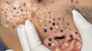 Big Cystic Acne Blackheads Extraction Blackheads amp Milia Whiteheads Removal Pimple Popping  5553 [upl. by Narod]