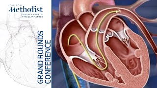 Management of Group 2 Pulmonary Hypertension Hope or Hype Raymond L Benza MD February 17 2022 [upl. by Ambrosane]