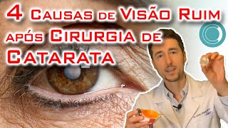 Causas de visão ruim após cirurgia de catarata [upl. by Garratt481]