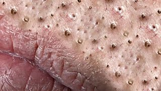 Big Cystic Acne Blackheads Extraction Blackheads amp Milia Whiteheads Removal Pimple Popping  1201 [upl. by Onaicul]