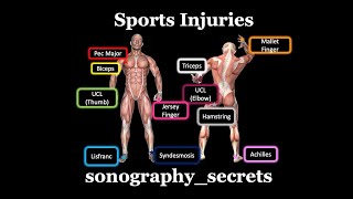 Ultrasound of Sports injuries by sonographysecrets [upl. by Marigolda530]