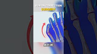 Bunion Correction Surgery Medical Animation 3D bunion toe [upl. by Demp]