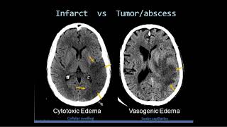 Intro to Head CT Part II Evaluation of Ischemic Stroke [upl. by Kiersten258]