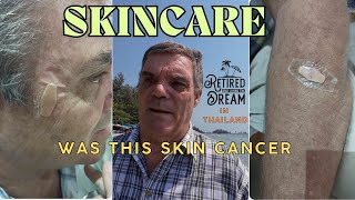 Warning signs of skin cancer Dont ignore these [upl. by Anyzratak]